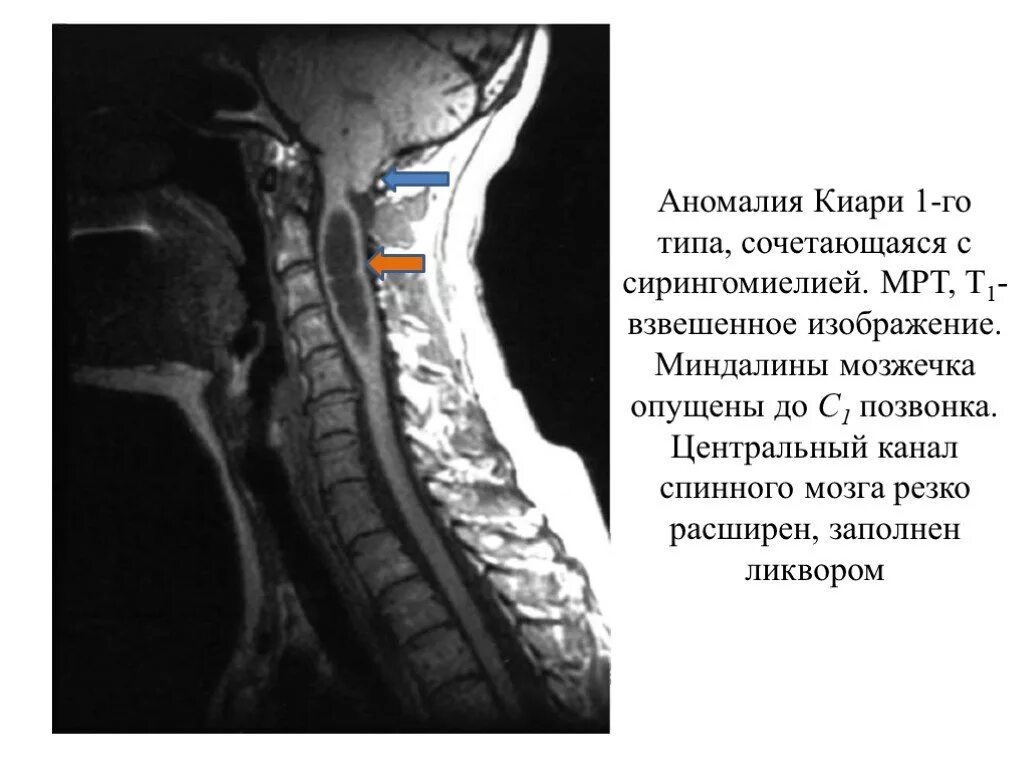 Аномалия Киари 1 типа на мрт. Сирингомиелия миелография. Сирингомиелия грудного отдела мрт позвоночника.