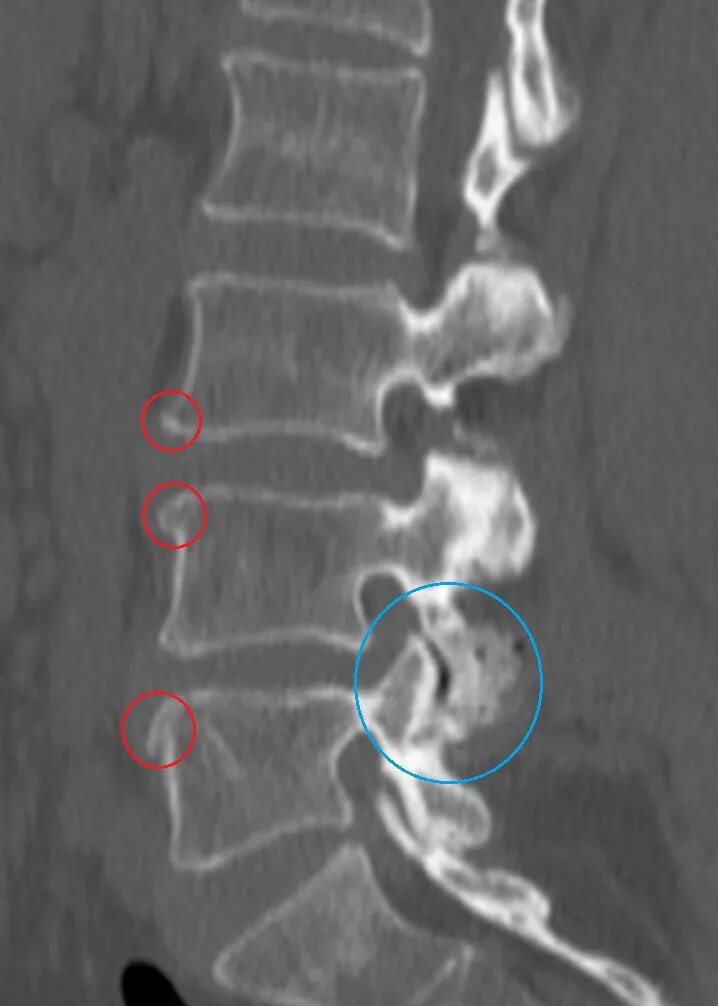 Спондилоартроз грудного отдела на рентгене. Спондилез поясничного отдела рентген. Деформирующий спондилез l2 l5. Спондилез и остеохондроз поясничного отдела позвоночника. Спондилез l3