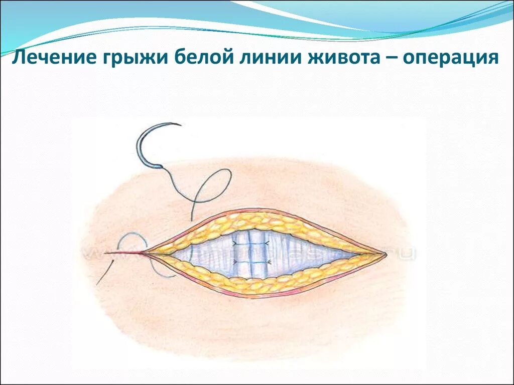 Лечение живота операции. Грыжа на животе и белой линии живота. Грыжи грыжа белой линии живота. Герниопластика грыжи белой линии живота. Грыжа белой линии живота операция.