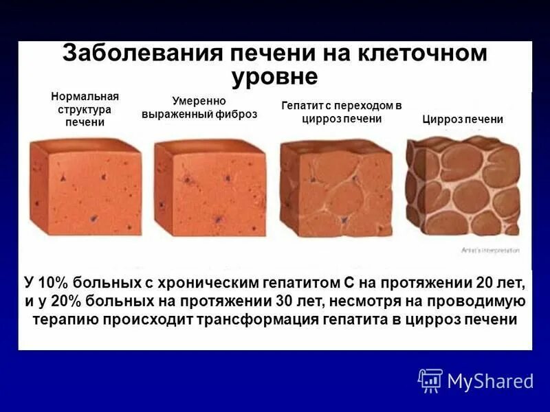 Крупнозернистая структура печени на УЗИ. Зернистая структура печени. Мелкозернистая структура печени. Крупнозернистая структура печени.