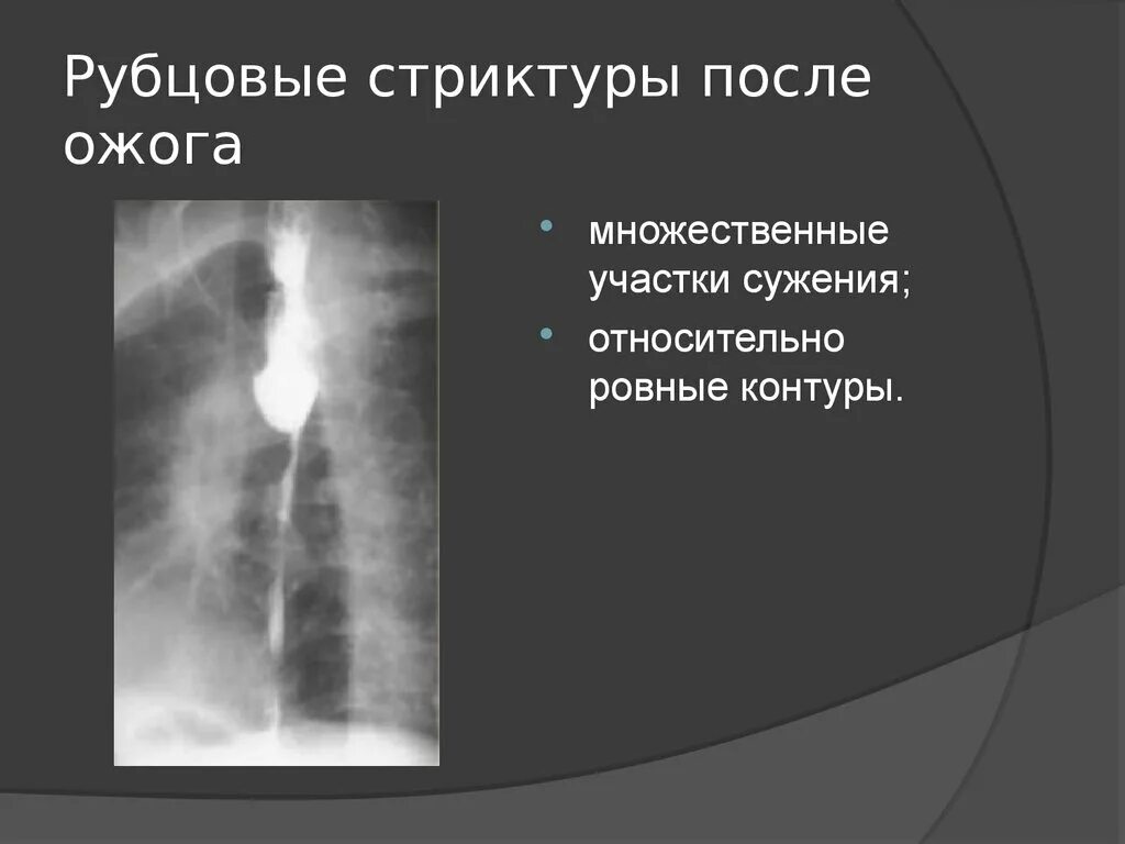 Рубцовые сужения пищевода. Бужирование стриктуры пищевода. Химические ожоги и рубцовые сужения пищевода. Стеноз пищевода рентген. Рубцовое сужение пищевода.