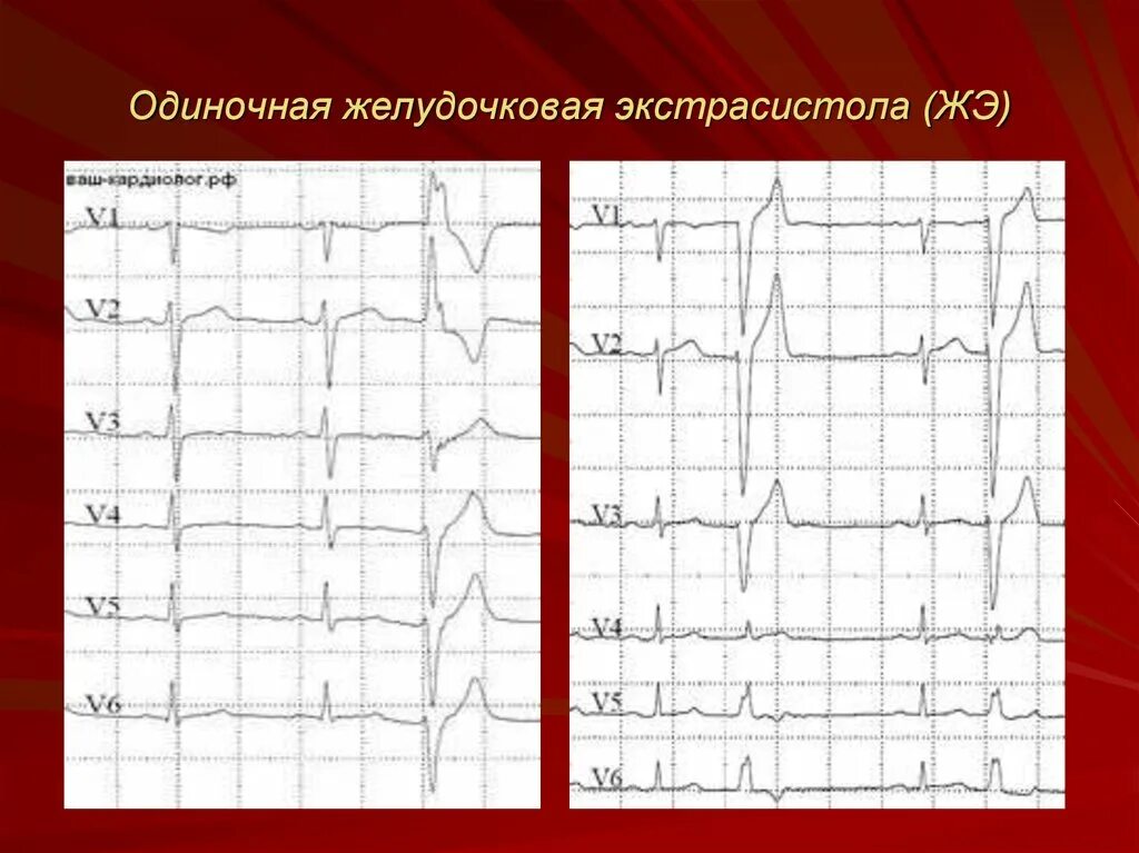 Желудочковая экстрасистолия на ЭКГ. Единичная желудочковая экстрасистолия на ЭКГ. Полиморфная желудочковая экстрасистолия. ЭКГ одиночная желудочковая экстрасистола. Одиночные экстрасистолы нормы