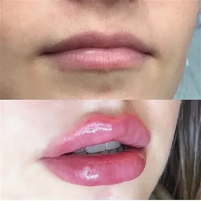 Нарощенные губы
