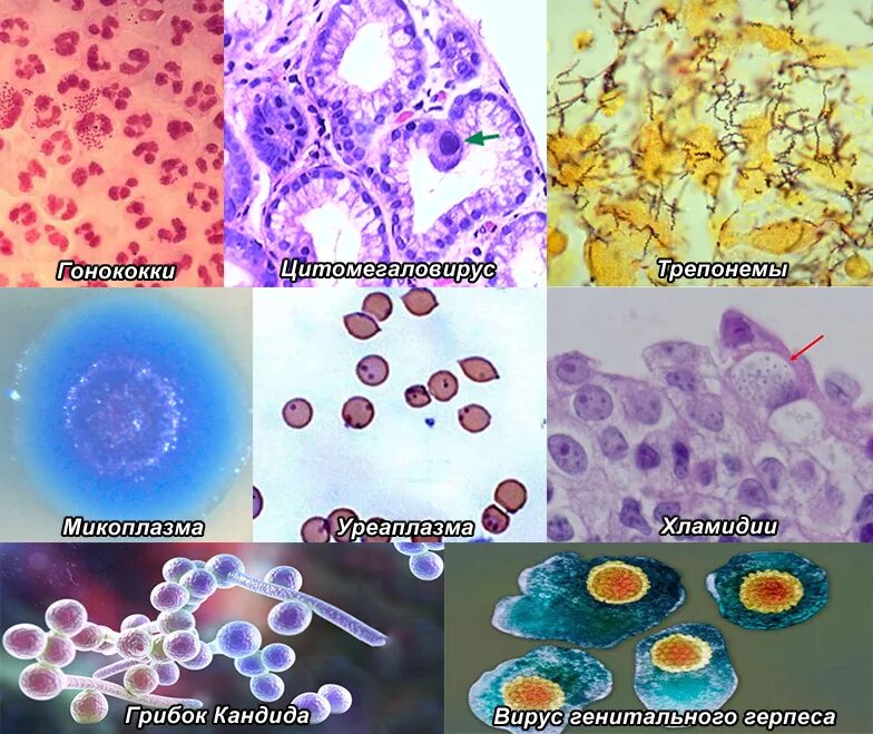 Chlamydia trachomatis mycoplasma genitalium. Хламидии - возбудители урогенитальных инфекций. Урогенитальный хламидиоз микроскопия. Хламидии микробиология заболевания.