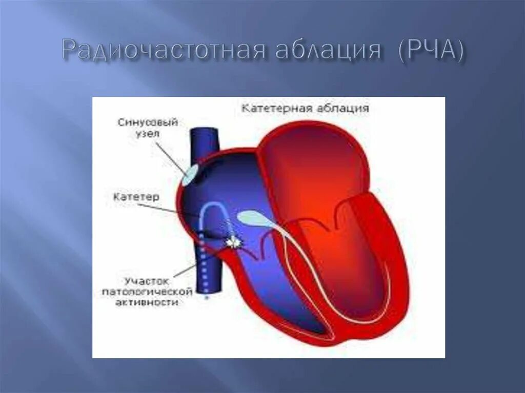 Рча предсердий. Катетерная аблация нарушений ритма (РЧА 2 категории сложности).