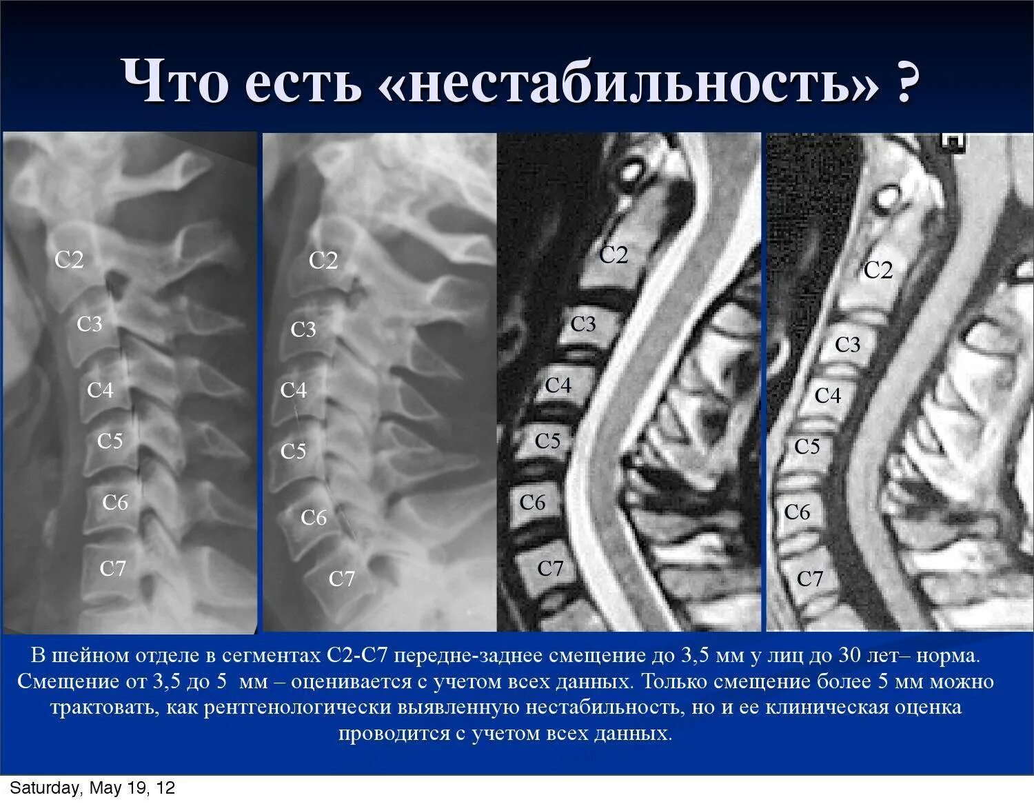 Спинальная нестабильность что это. Лестничная нестабильность шейных позвонков на рентгене. Гипермобильность позвонков шейного отдела рентген. Сегмент с4-с5 шейного отдела позвоночника. Нестабильность шейного отдела позвоночника с2-с7.