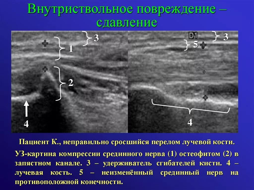 Повреждение периферических нервов. УЗИ периферического нерва. Внутриствольное повреждение нерва. Разрыв нерва на УЗИ. УЗИ срединного нерва.