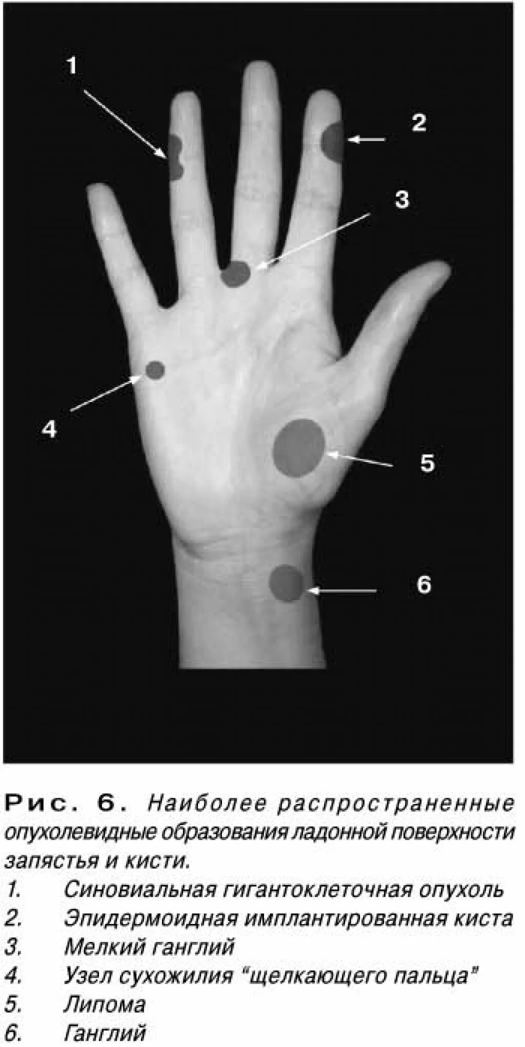 Сухожильный ганглий лучезапястного сустава. Образование на ладонной поверхности кисти. Гигрома ладонной поверхности кисти. Поверхность запястья
