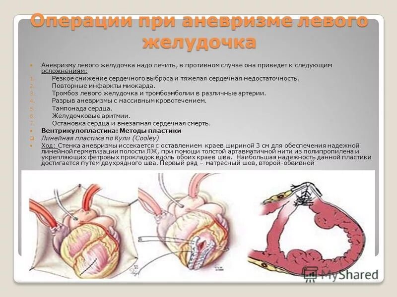 Хроническая аневризма сердца ИБС. Осложнения острой аневризмы левого желудочка. Аневризма левого желудочка сердца. Пластика аневризмы левого желудочка. Аневризма сердца что это такое симптомы