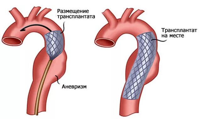 Стентирование аневризмы. Стент графт грудной аорты. Стентирование аневризмы аорты. Стент графт аорты операция. Аневризма аорты стент графтом.