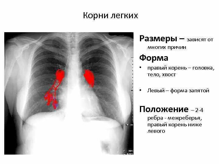 Увеличение корень легкого. Головка левого корня легкого. Структура корня легкого. Хвост корня легкого. Размеры корня легкого.