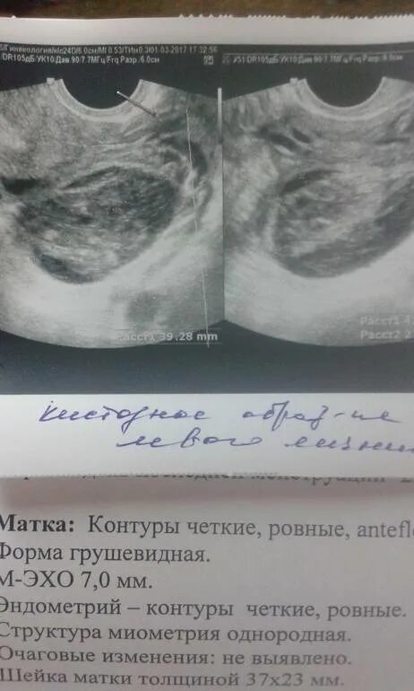 Задержка месячных тест отрицательный киста яичника. Жёлтое тело на узи при беременности на ранних сроках. киста на яичнике при беременности на ранних. если киста на яичнике при беременности. киста правого яичника при беременности на ранних сроках.