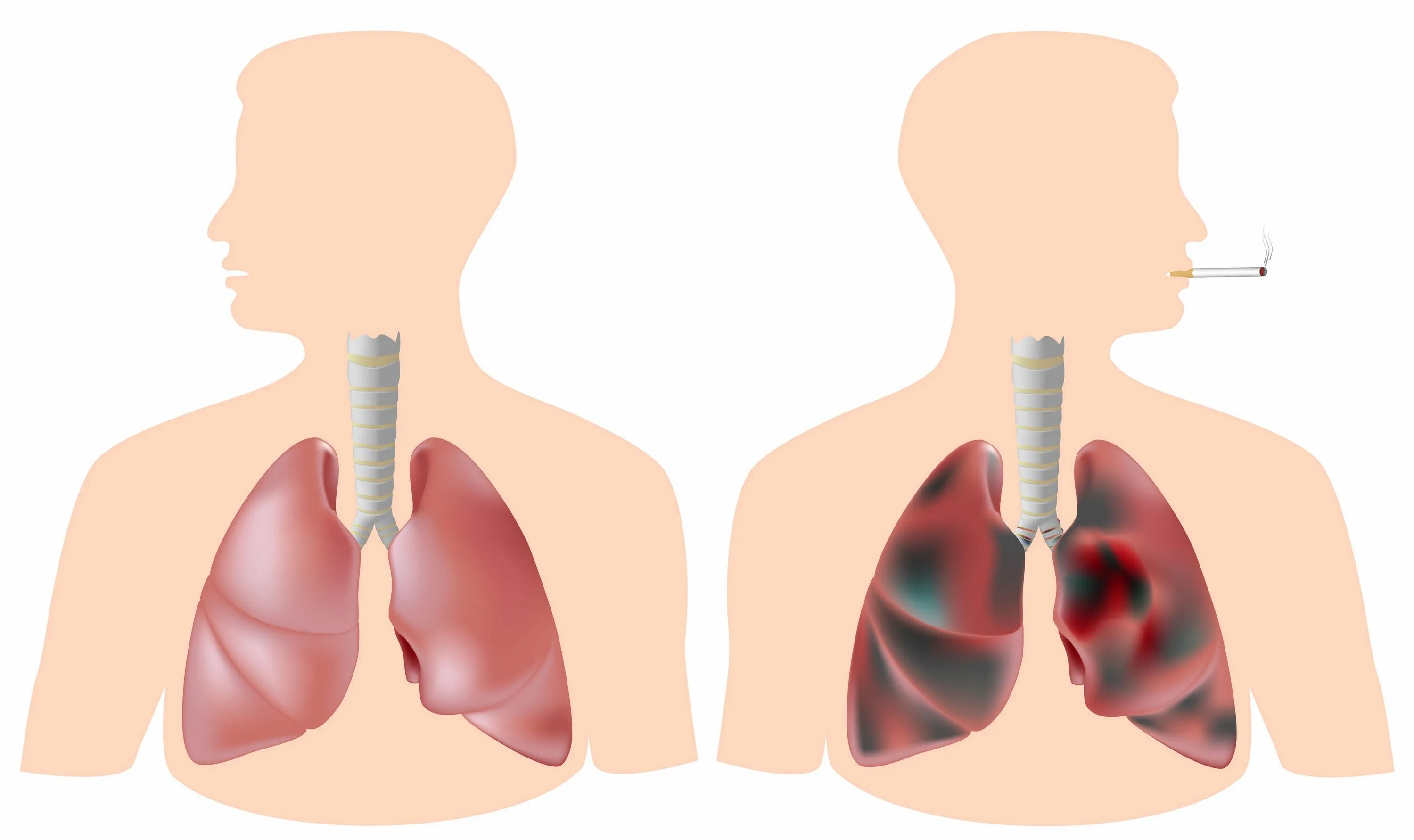 Бронхи курильщика и здорового человека. Лёгкие курящего человека и лёгкие здорового человека. Лёгкие здорового человека и курильщика.