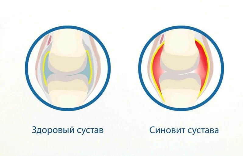 Стадии развития синовита. Синовит коленного сустава. Стадии синовита коленного сустава.