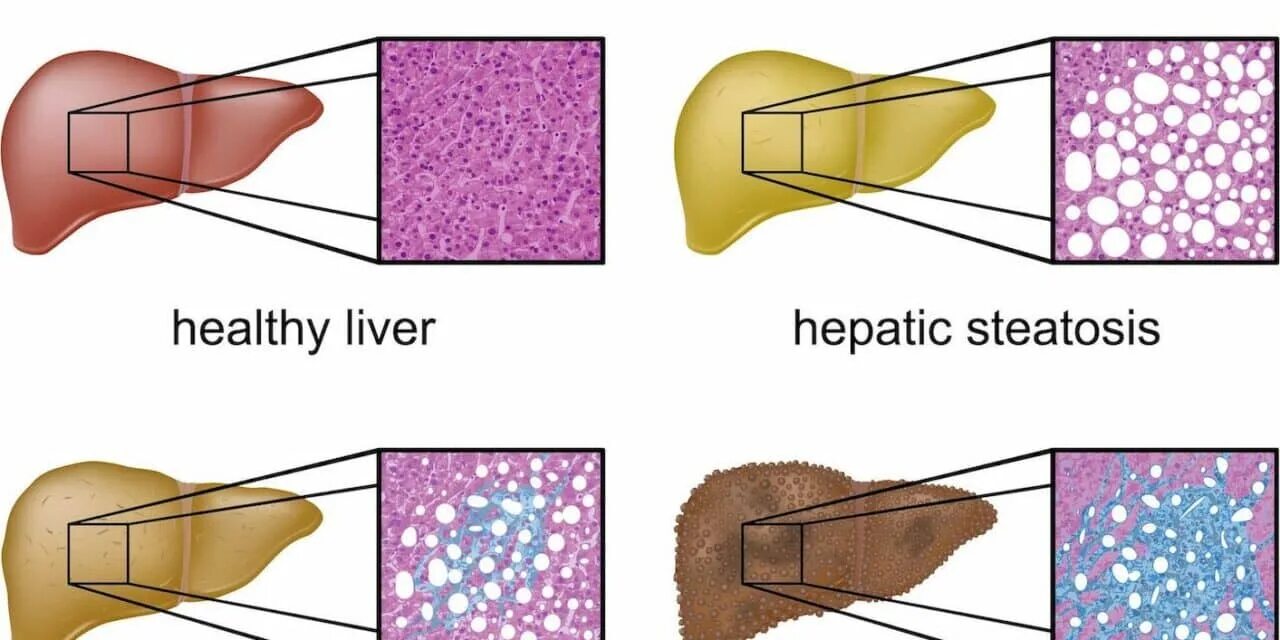Печень сальные железы. Степени жировой инфильтрации печени. Жировая инфильтрация печени стеатоз. Патогенез фиброза печени. Жировой гепатоз (стеатоз) печени.