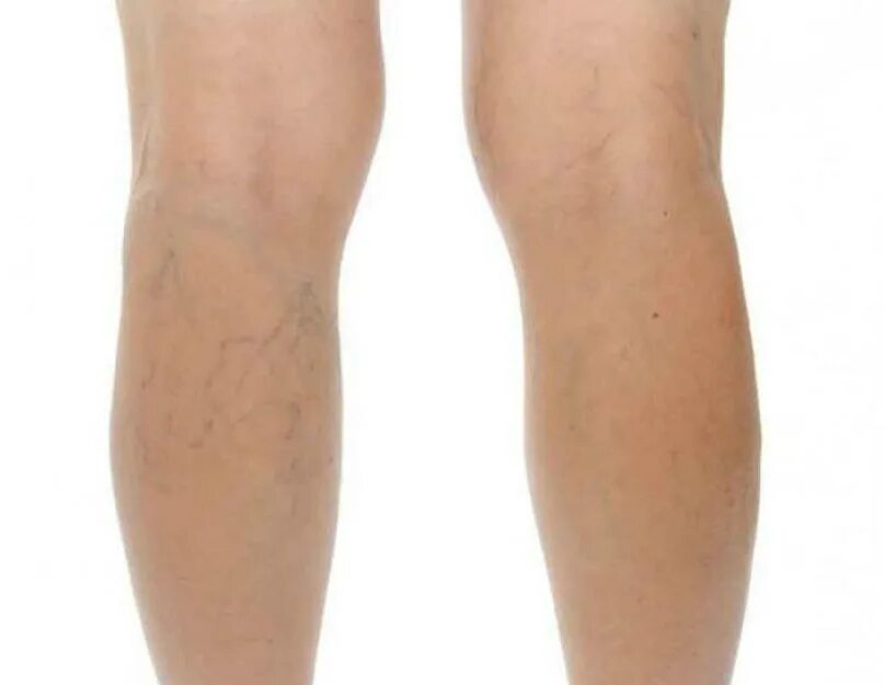 Расширение вен при беременности. Варикозное расширение вен при беременности. Стадии клинического течения варикозного расширения вен. Варикозное расширение вен у беременных. Варикозное расширение вен при беременности.