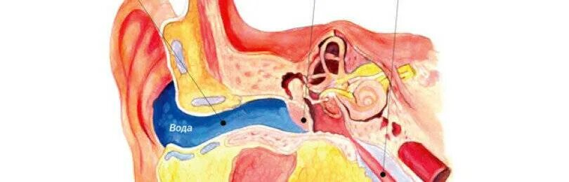 Вода попала в среднее ухо.
