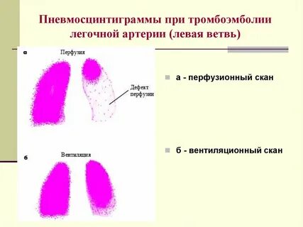 Тромбоэмболия левой легочной