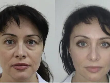 Подтянуть веки операция