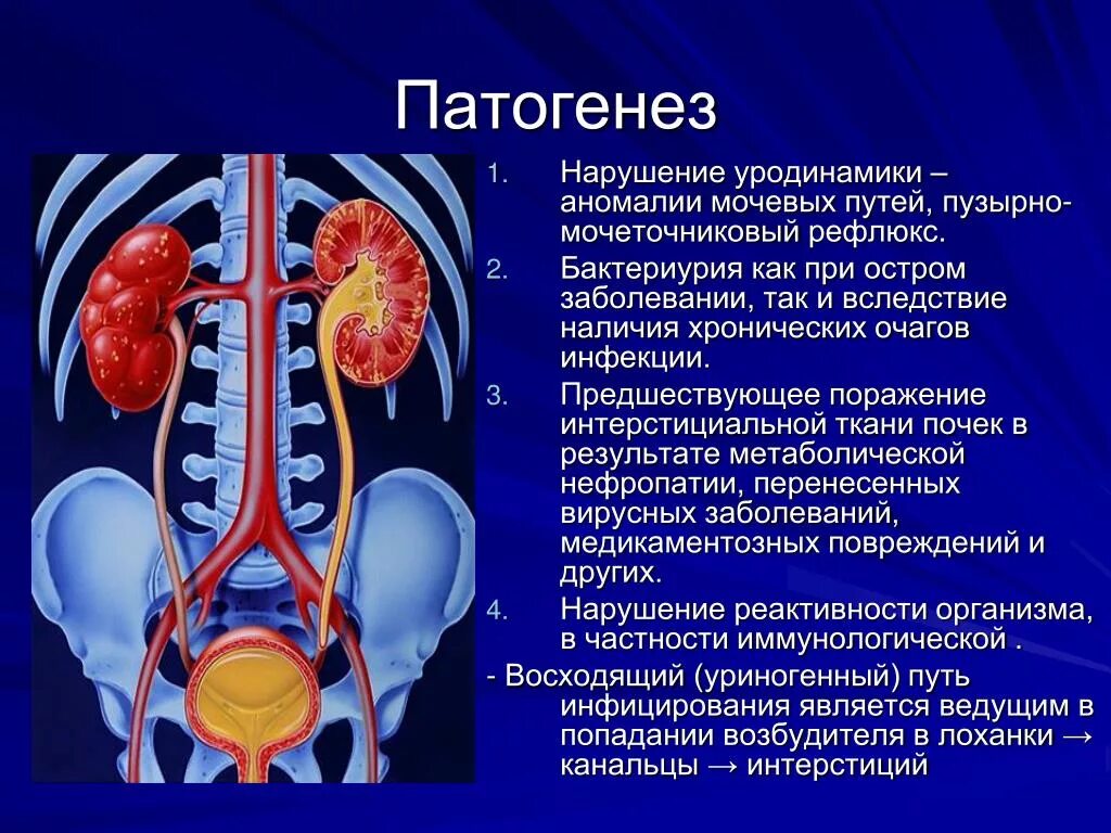 Заболевание почек особенности. Патогенез пузырно мочеточникового рефлюкса. Этиология поликистоза почек. Патогенез поликистоза почек. Болезни почек и мочевыделительной системы.