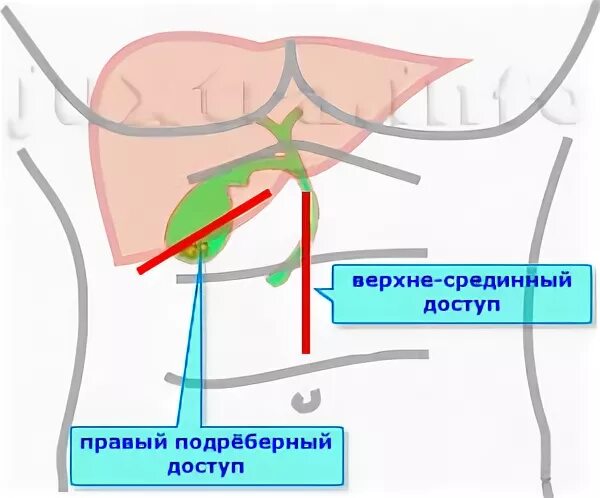 Компрессионные чулки после операции лапароскопии