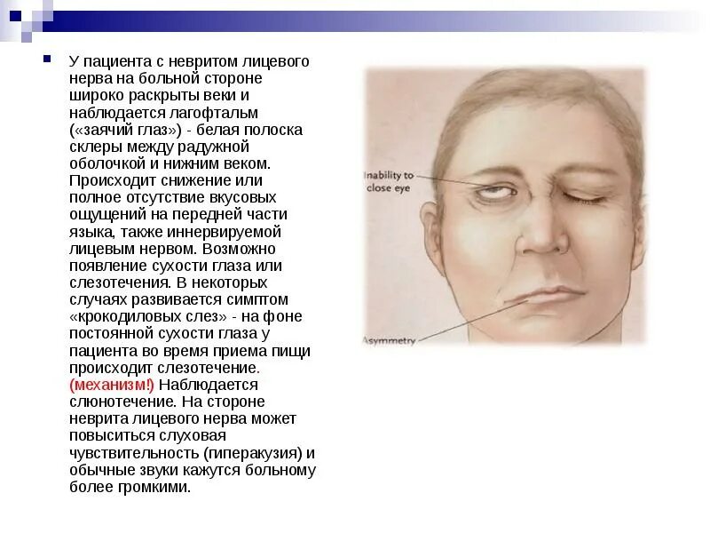 Невропатия лицевого нерва локальный статус. Неврит лицевого нерва. Неврит лицевого лицевого нерва. Воспаление тройничного лицевого нерва.