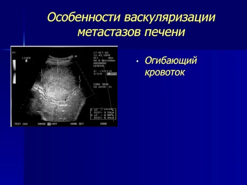 Образования печени по УЗИ. Очаговые образования в печени на УЗИ. Васкуляризация печени. Метастатическое поражение печени УЗИ. Рак метастазы в печень лечение