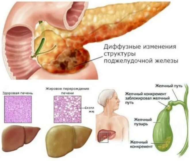 Изменения поджелудочной железы форум