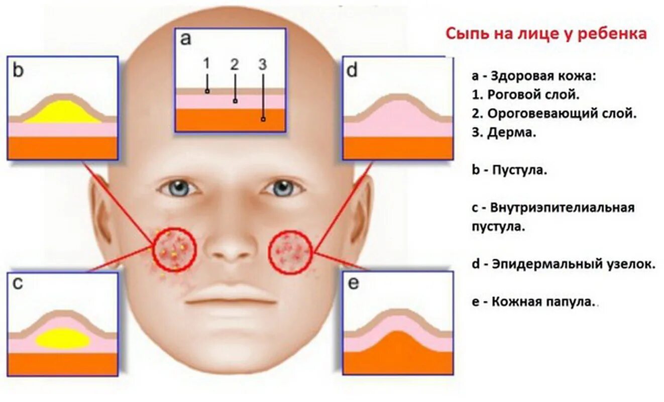 температура прыщи лице