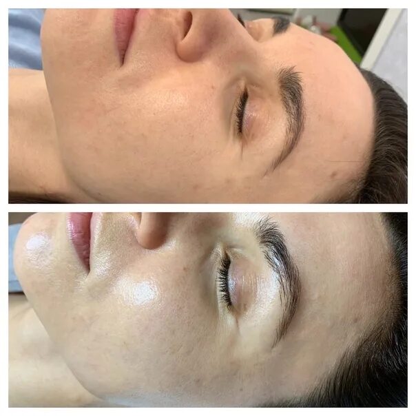 Пилинг биорепил для лица до после Buy Chemical Peelings Online