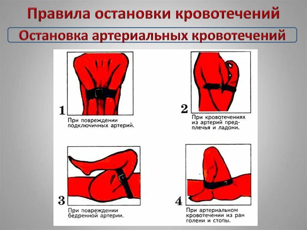 Как остановить сильную кровь. Порядок остановки кровотечения. Остановка артериального кровотечения. Порядок остановки артериального кровотечения. Кровотечение схема.