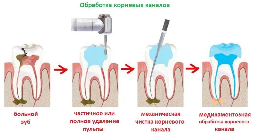 Зуб чувствителен после лечения. Пульпит 2 канального зуба. Корневой канал при воспалении пульпы пломбируют.