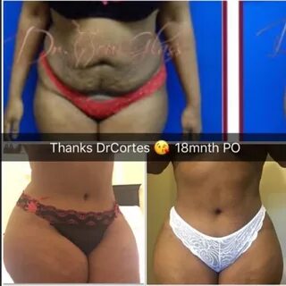 Hourglass Tummy tuck hr Before and after Hourglass Tummy Tuck Surgery.
