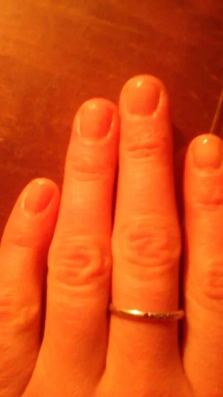 Лейконихия продольная. Химический онихолизис. Плохо растут ногти на руках. Ониходистрофия - онихолизис. Тонкие ногти.