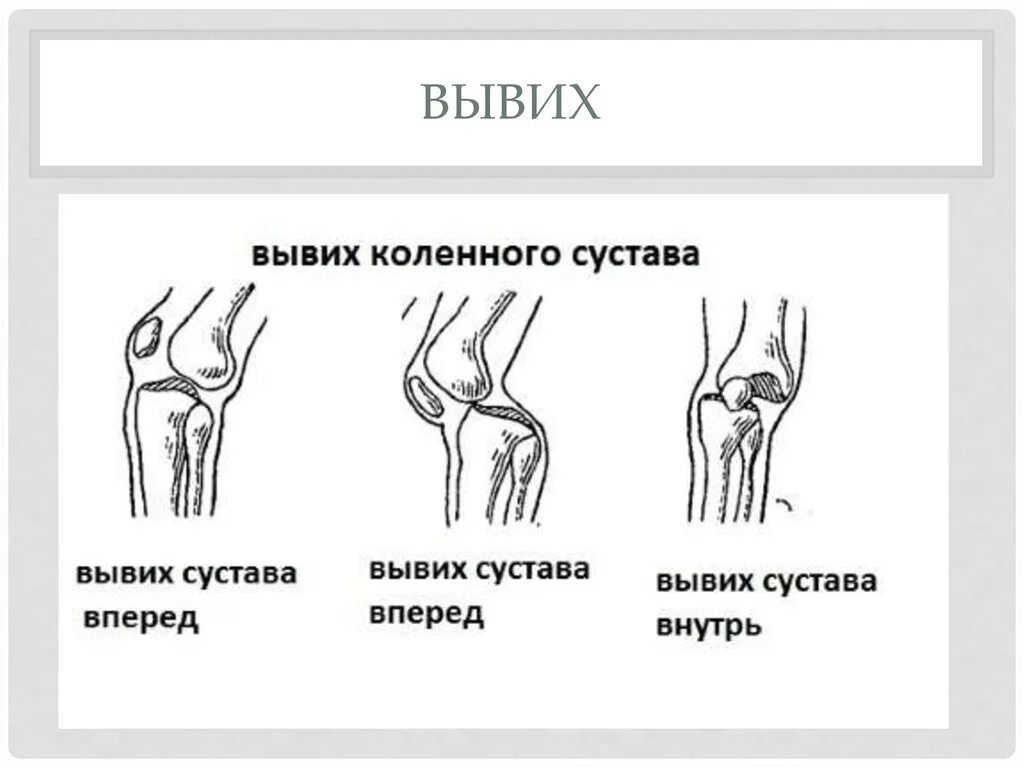 Какой вид травмы показан на рисунке. Вывих коленного сустава схема. Строение сустава с вывихом. Схема вывиха и подвывиха сустава.