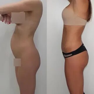 Липофилинг грудных желез до и после