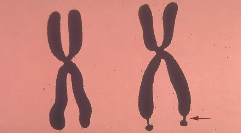 Отсутствие х хромосомы у мужчин