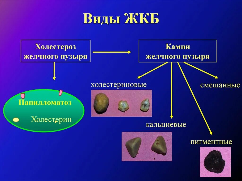 Холестерин в желчном пузыре. Холестериновые камни в желчном пузыре. Камни желчогопузыря виды. Холестериновые и пигментные камни желчного пузыря.