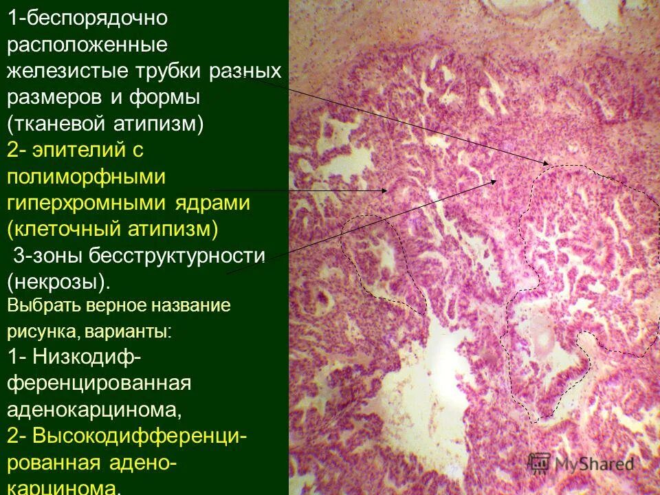 Тканевой атипизм опухолей. Опухоли из эпителиальной ткани. Опухоли железистого эпителиальной ткани. Опухоли из эпителия нервной и меланинобразующей ткани. Клетки с гиперхромными ядрами