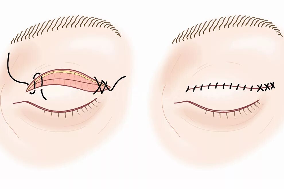 Швы при блефаропластике. На веко накладывают шов.