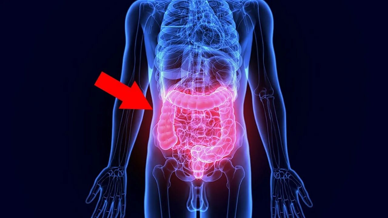 Воспалительные заболевания кишечника. Bowel disease. Bowel disease. Bowel disease. Заболевания органов пищеварения.