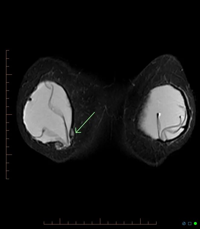 Импланты грудных желез. Контрактура грудных имплантов. Капсулярная контрактура грудного импланта мрт. Контрактура импланта молочных желез кт. Внутрикапсульный разрыв импланта мрт.
