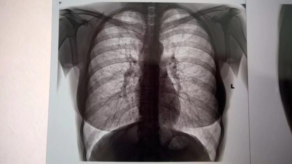 Что видно на рентгене легких