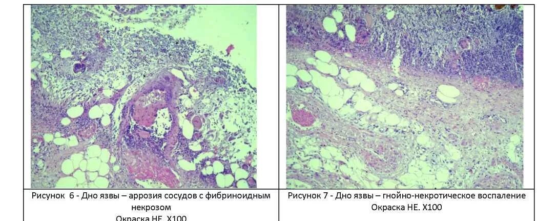 Хроническая язва желудка микропрепарат.