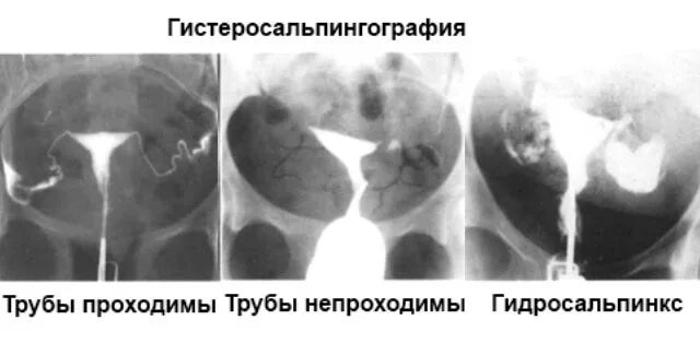 Гидросальпинкс этиология. ГСГ маточных труб не проходиимы. Бессимптомный гидросальпинкс. Гидросальпинкс лечение операции