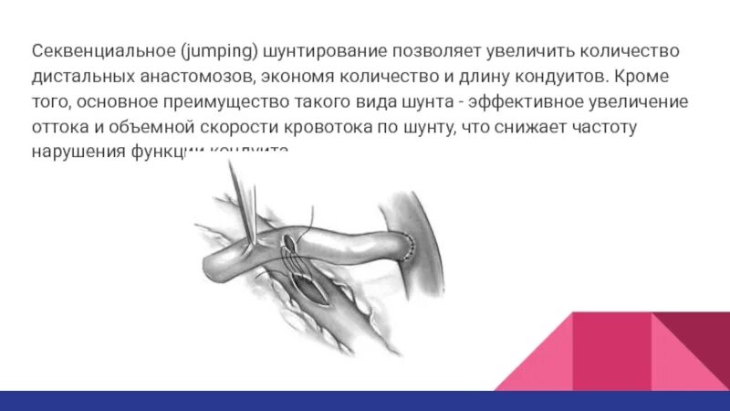 Секвенциальное аортокоронарное шунтирование. Коронарное шунтирование операция.