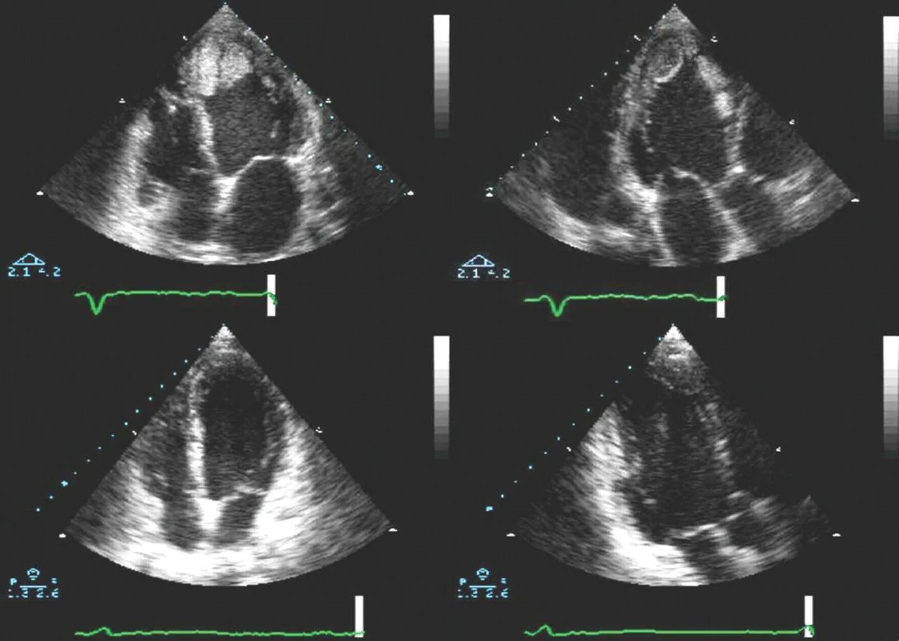 Эхо кардиография. ЭХОКГ при миокардите. Эхокардиография при миокардите. ЭХОКГ УЗИ сердца. Эхокардиография Эхо кг УЗИ сердца.