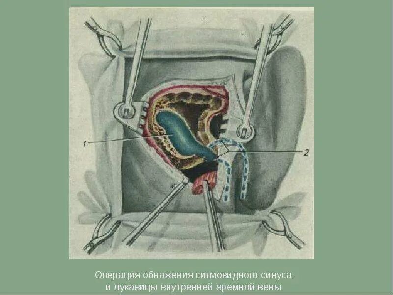 Как делается операция уха. Радикальная общеполостная операция на ухе. операция сигмовидного синуса. санирующая операция на среднем ухе. операция при отите среднего уха.