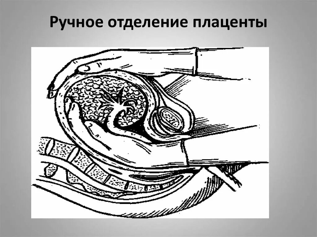 Выходит матка после родов. Методика ручного отделения последа.. Ручное отделение плаценты и выделение последа. Методы выделения последа в ручную. Ручное извлечение плаценты.