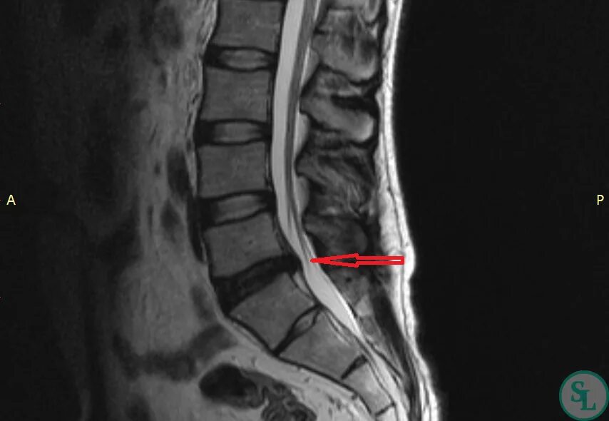 Грыжа диска l5 s1 что это. Грыжа l5-s1. L5-s1 межпозвонковая грыжа. Грыжа межпозвоночного диска l5-s1. Грыжа Шморля l5-s1.